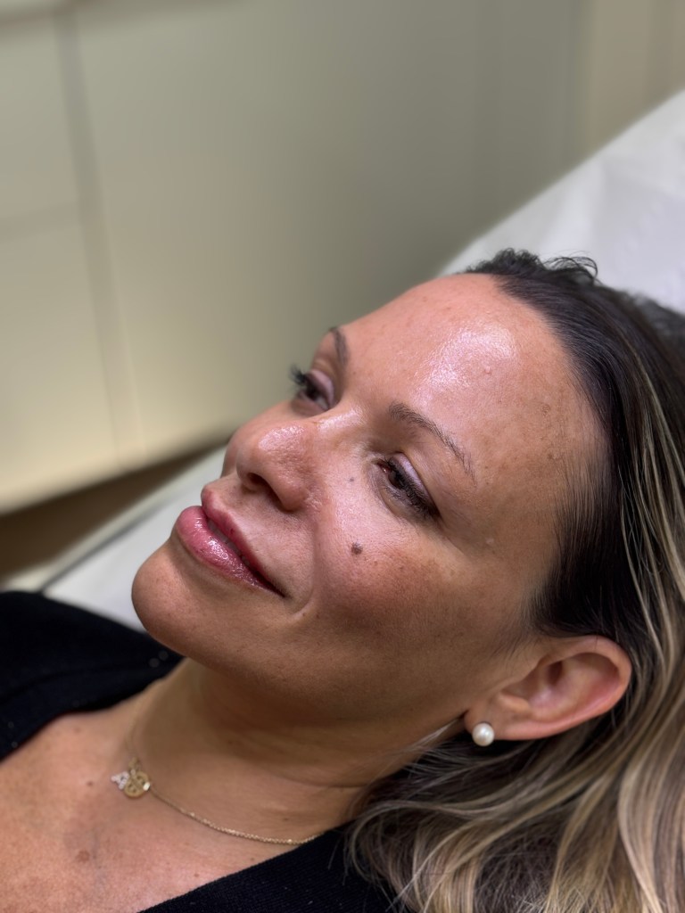 Client showing Lip Augmentation